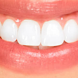 Thinking about veneers? See our dentists in Boise & Eagle, we help our patients hide chipped teeth and irregular gaps.