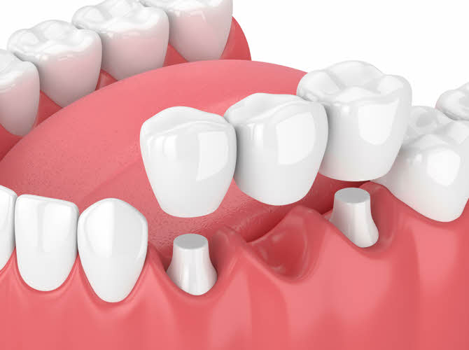 Say goodbye to the holes in  your smile, our dentists in Boise and Eagle will provide you with bridges, and full or partial dentures that look like your natural teeth.