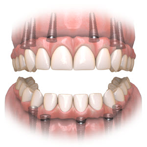 Click here for full overview of the Hybridge Full Arch Dental Implant Bridge.