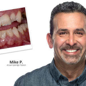 View before and after images of patients who have received the Hybridge Full Arch treatment.