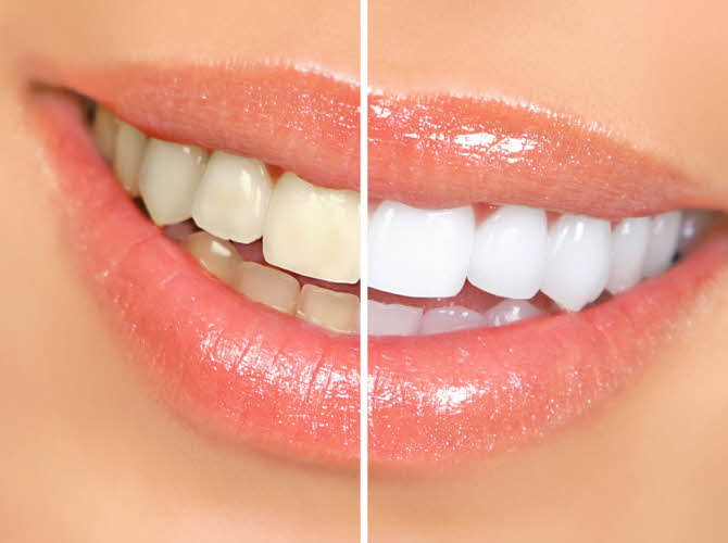 Want to make those teeth white again? Our dentists have a great whitening progam you can do in the comfort of your own home.