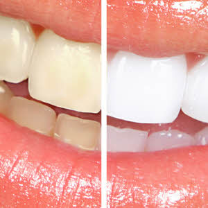 We offer teeth whitening for life, ask your dentist at any of our Parkway Dental locations in Boise & Eagle.